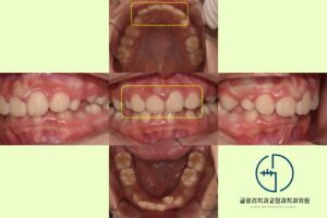 Read more about the article 악궁 확장 후 상악 4전치 배열 완료! 중랑구 치과 어린이 교정 케이스