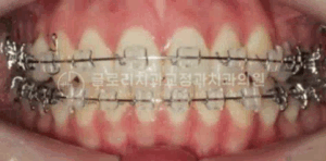 Read more about the article 상봉동 치과 MARPE(악궁확장장치)를 사용한 개방교합 개선 증례
