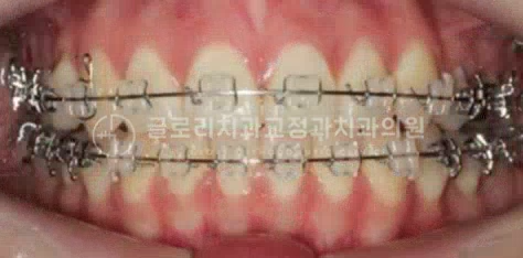 You are currently viewing 상봉동 치과 MARPE(악궁확장장치)를 사용한 개방교합 개선 증례