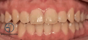 Read more about the article 중화동 치과 윗니가 아랫니를 너무 깊게 물어요. 전치부 과개교합(deep bite) 개선 증례