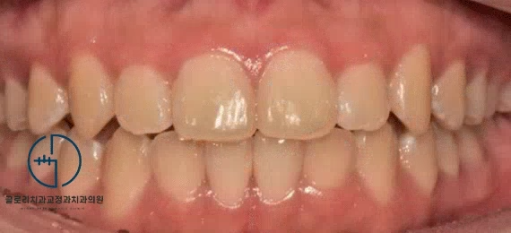 You are currently viewing 중화동 치과 윗니가 아랫니를 너무 깊게 물어요. 전치부 과개교합(deep bite) 개선 증례
