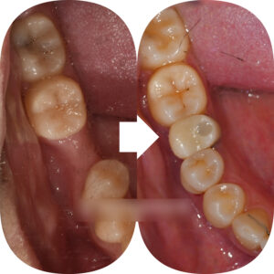 Read more about the article 어금니 상실, 중랑구 치과 사랑니 견인 교정으로 올바른 위치에 끌어쓸 수 있을까?