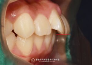Read more about the article 망우동 치과 고등학생 치아교정 케이스 앞니 돌출 치아배열 가지런하게 개선