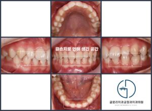 Read more about the article 아래 앞니 결손치 임플란트 전 치아교정 상봉동 치과추천