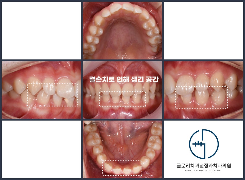 You are currently viewing 아래 앞니 결손치 임플란트 전 치아교정 상봉동 치과추천