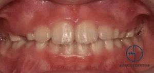 Read more about the article 망우동 교정치과 “우리 아이 양쪽 턱이 삐뚤어요.” 어린이 안면비대칭