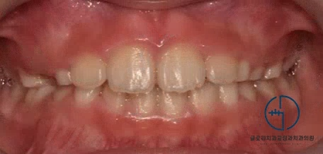 You are currently viewing 망우동 교정치과 “우리 아이 양쪽 턱이 삐뚤어요.” 어린이 안면비대칭