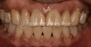 Read more about the article 성인 부분교정, 어떤 것들을 고려하여 진행해야 되는걸까? 중랑구교정치과