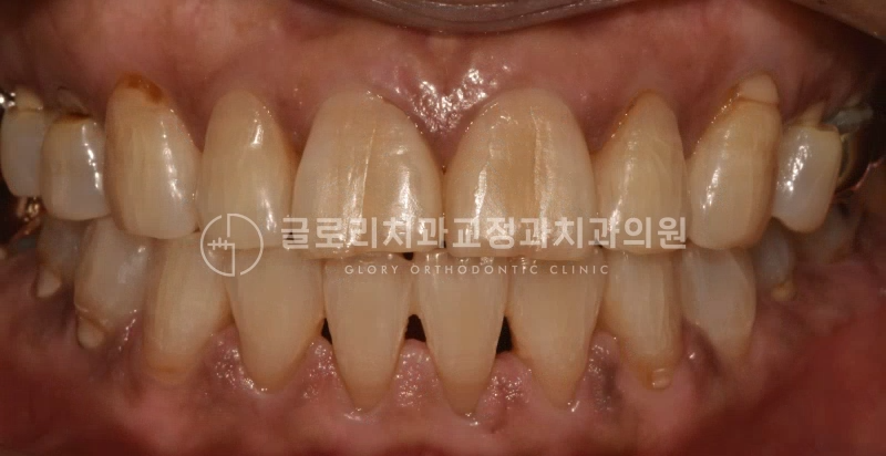 You are currently viewing 성인 부분교정, 어떤 것들을 고려하여 진행해야 되는걸까? 중랑구교정치과