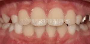 Read more about the article 6개의 치아에만 붙이는 장치가 있다? 망우본동 교정치과 2×4 appliance를 사용한 어린이 치열 개선