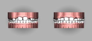 Read more about the article 티 안 나는 세라핀 투명교정, 어떤 장점을 갖고 있을지 교정치과 에서 알려드릴게요