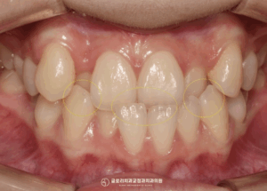 Read more about the article 심한 덧니와 주걱턱 치아교정 중화역 치과 에서 시행한 반대교합 개선 과정