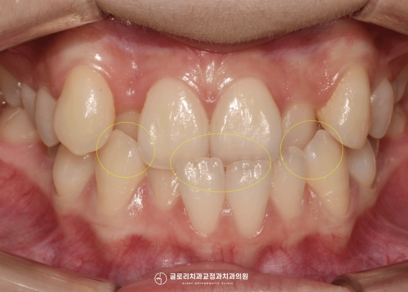 You are currently viewing 심한 덧니와 주걱턱 치아교정 중화역 치과 에서 시행한 반대교합 개선 과정