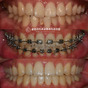 Read more about the article 유착치(ankylosis)를 동반한 상봉동 교정치과 총생 비발치 개선 케이스