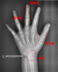Read more about the article “아이 앞니가 거꾸로 물려요.” 면목동 치과 성장기 3급 부정교합 치료 과정