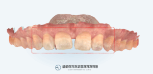 Read more about the article 벌어진 앞니 부분 교정 치료방법 면목동치과에서 개선 도와드렸습니다.