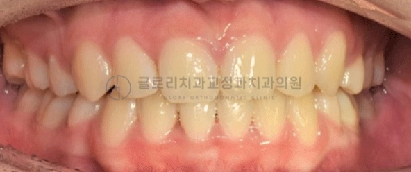 You are currently viewing 망우동 치과 에서 교정으로 쓰러진 어금니 세우기 (uprighting)