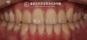 Read more about the article 위, 아랫니가 거꾸로 물리면 나타날 수 있는 문제들! 망우역 치과 고난도 교정 케이스
