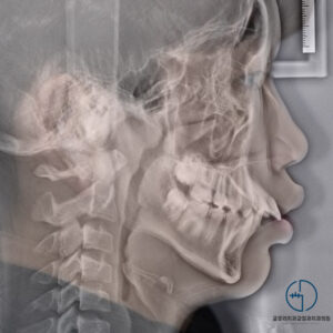 Read more about the article 벌어지고 돌출된 치아, 비발치로 진행할 수 있을까?! 중랑구 교정치과