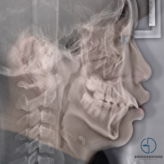 You are currently viewing 벌어지고 돌출된 치아, 비발치로 진행할 수 있을까?! 중랑구 교정치과