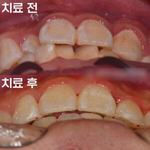 Read more about the article 망우역 치과 교정과 전문의 대표원장의 1:1 책임 진료 케이스, 심한 총생 및 과개교합 개선 증례