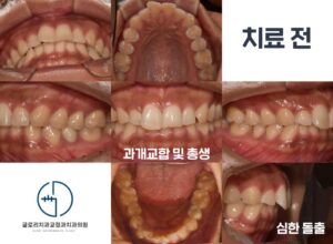 Read more about the article 상봉동 교정치과 과개교합 및 총생 개선으로 올바른 교합 형성하기