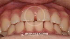 Read more about the article 벌어진 치아 사이(치간이개), 1년 반도 걸리지 않아 사이좋게 배열시켜드렸습니다. 망우역치과