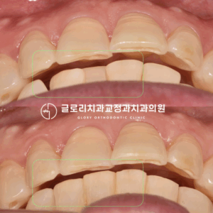 Read more about the article 눈에 띄지 않는 중랑구교정치과 설측 장치로 앞니 삐뚤어짐 개선 완료