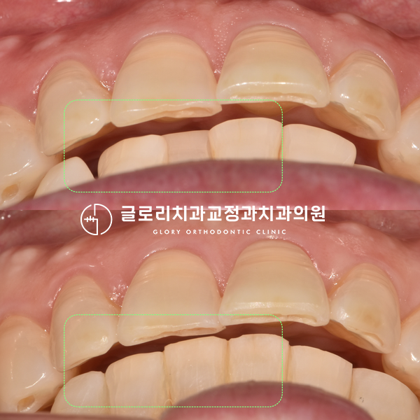 You are currently viewing 눈에 띄지 않는 중랑구교정치과 설측 장치로 앞니 삐뚤어짐 개선 완료