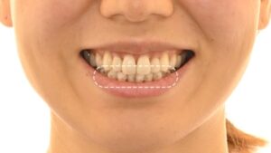 Read more about the article 앞니 전치부 아랫니 틀어짐 부분교정 치료로 충분히 개선 가능합니다