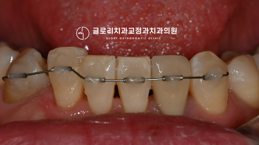 You are currently viewing 중랑구교정치과 3개월 만에 틀어진 치아가 고르게 바뀔 수 있다? MTA 부분 치료