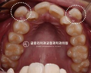 Read more about the article 여기저기 배열에서 벗어난 치아들, 망우동 치과 발치 교정으로 2년 만에 개선!