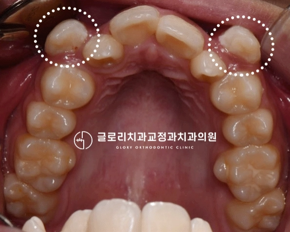 You are currently viewing 여기저기 배열에서 벗어난 치아들, 망우동 치과 발치 교정으로 2년 만에 개선!