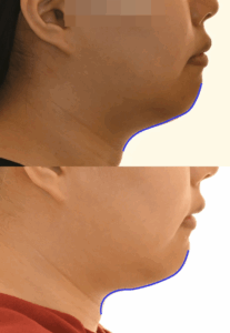 Read more about the article 양원역 치과 무턱 덧니처럼 보이는 총생 있다면 치아교정 치료로 개선 가능할까?
