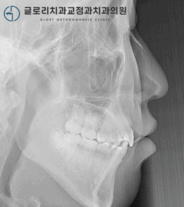 Read more about the article 망우동 치과 툭 튀어나온 돌출입, 소구치 발치 교정