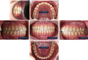 Read more about the article 망우역 글로리 치과 치아 사이 공간 (spacing)을 모으는 치료 증례
