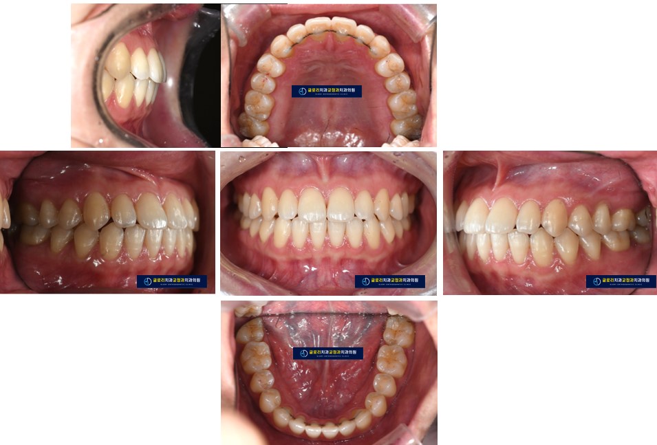 You are currently viewing 망우역 글로리 치과 치아 사이 공간 (spacing)을 모으는 치료 증례