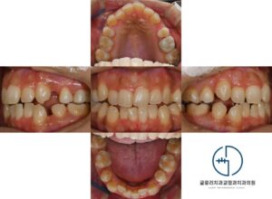 Read more about the article 중랑구 교정치과 에서 알려드리는 인비절라인 시작 전 알아두면 좋은 내용! (+ 실제 환자분의 진행 과정)