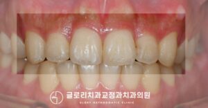 Read more about the article 디지털 스캔을 사용한 중랑구 치과 부분교정 케이스