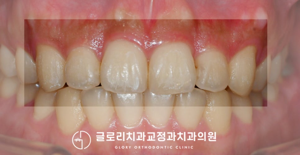 You are currently viewing 디지털 스캔을 사용한 중랑구 치과 부분교정 케이스