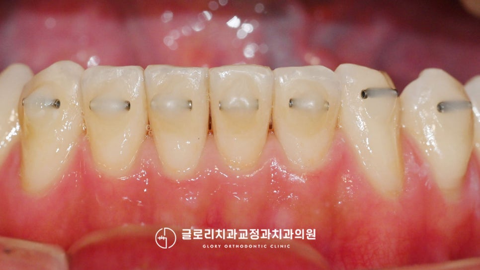 You are currently viewing 망우동 치과 MTA 미니 튜브 앞니 급속 부분으로 치아교정 재발 개선해 드렸던 케이스