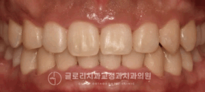 Read more about the article 과개교합(deep bite) 발생 원인 및 방치하면 안 되는 이유 중랑구 교정치과