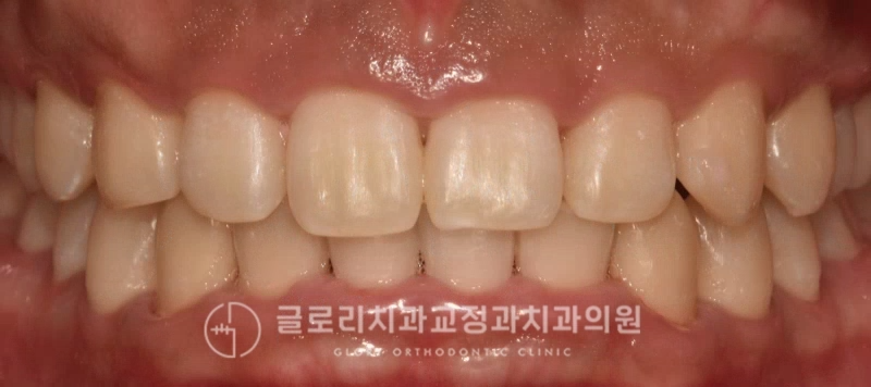 You are currently viewing 과개교합(deep bite) 발생 원인 및 방치하면 안 되는 이유 중랑구 교정치과