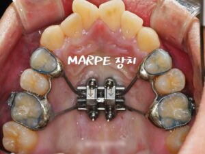 Read more about the article 면목동 치과 틀어진 앞니(나비 치아)가 고민인 20대 환자, 상악골 확장 marpe 활용해 비발치 교정으로 도와드린 사례