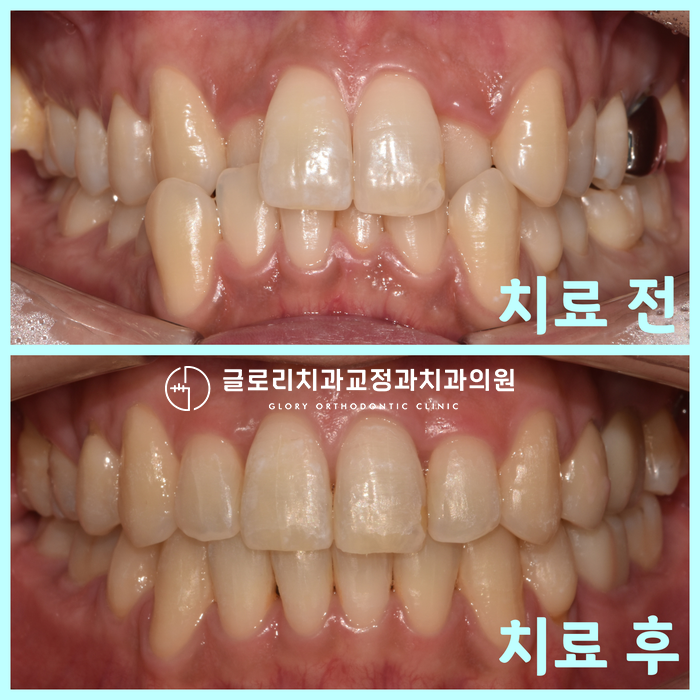 “이가 너무 삐뚤빼뚤 해요.” 망우역교정치과 30대 치열 개선 케이스