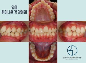 Read more about the article 상악골 확장을 동반한 비발치 돌출입 개선! 전문의 원장이 진료하는 중랑구 교정치과