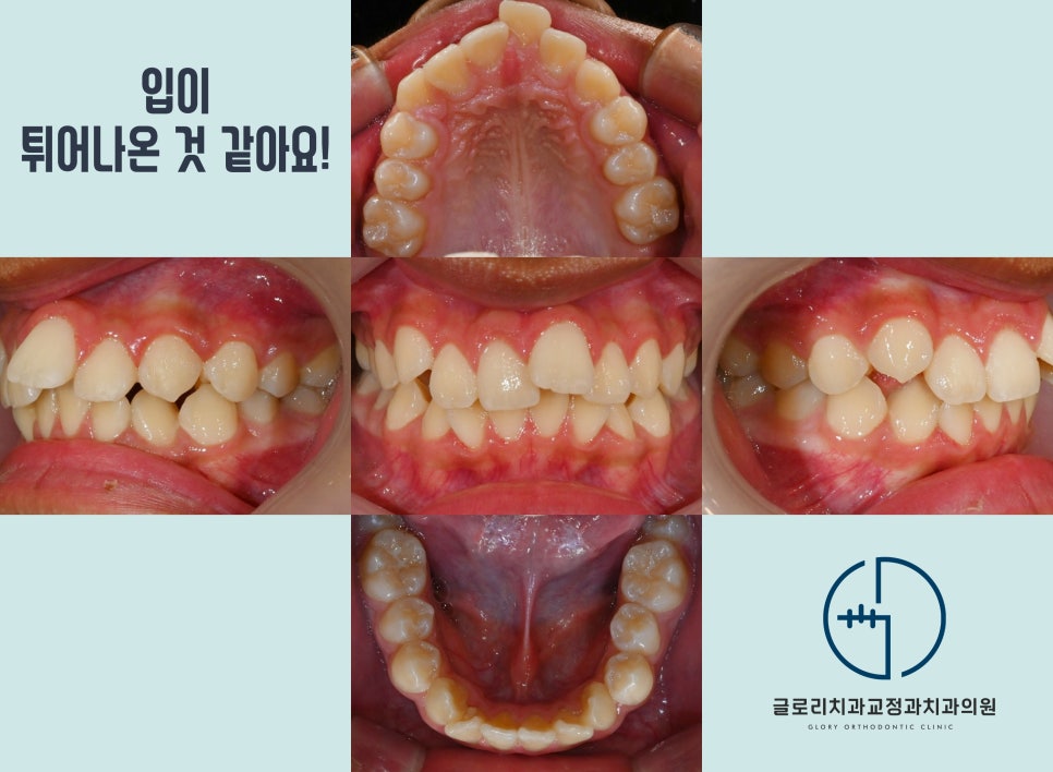 You are currently viewing 상악골 확장을 동반한 비발치 돌출입 개선! 전문의 원장이 진료하는 중랑구 교정치과