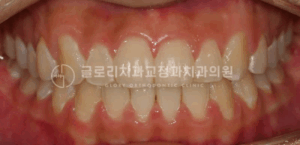 Read more about the article “덧니 때문에 입이 잘 안 다물어져요!” 면목동교정치과 하이캐나인 (High Canine) 치료 증례