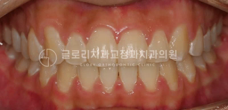 You are currently viewing “덧니 때문에 입이 잘 안 다물어져요!” 면목동교정치과 하이캐나인 (High Canine) 치료 증례