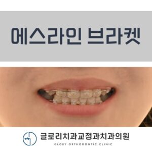 Read more about the article 에스라인 브라켓이라 들어보신 적 있으신가요!? 중화동 치과 툭 튀어나온 돌출입 및 치열 개선 과정